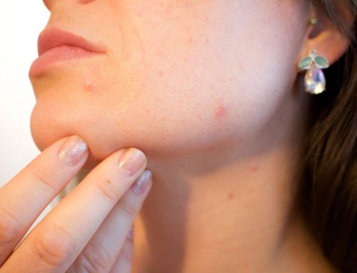 Falsos mitos sobre el acné